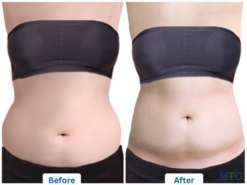 Before and after image of tummy tuck procedure