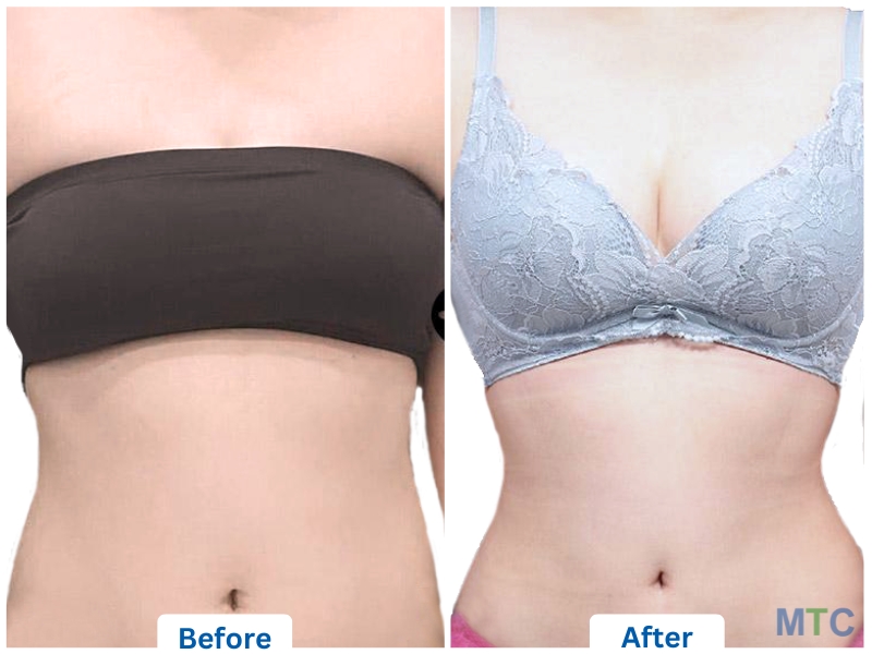 Before and after image of tummy tuck procedure