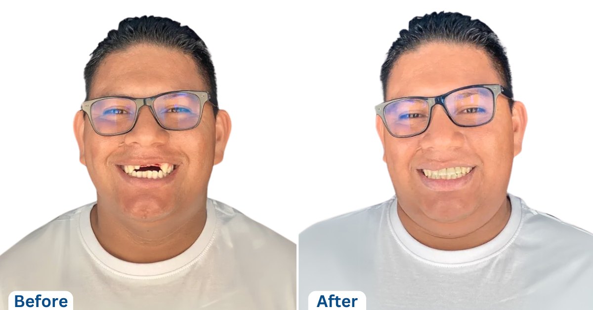 Dental Implants in Tijuana, Mexico