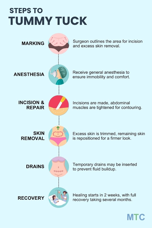 An infographic depicting the different steps involved in the tummy tuck procedure.