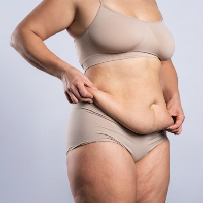 A women with Sagging Abdominal Skin