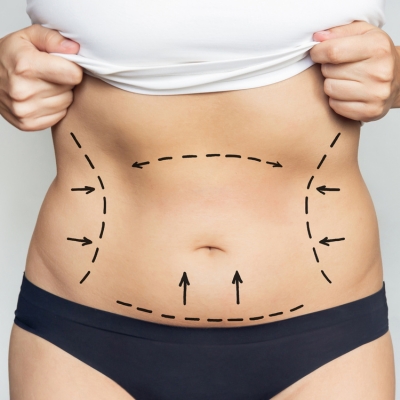 Image of outline for the Tummy Tuck procedure