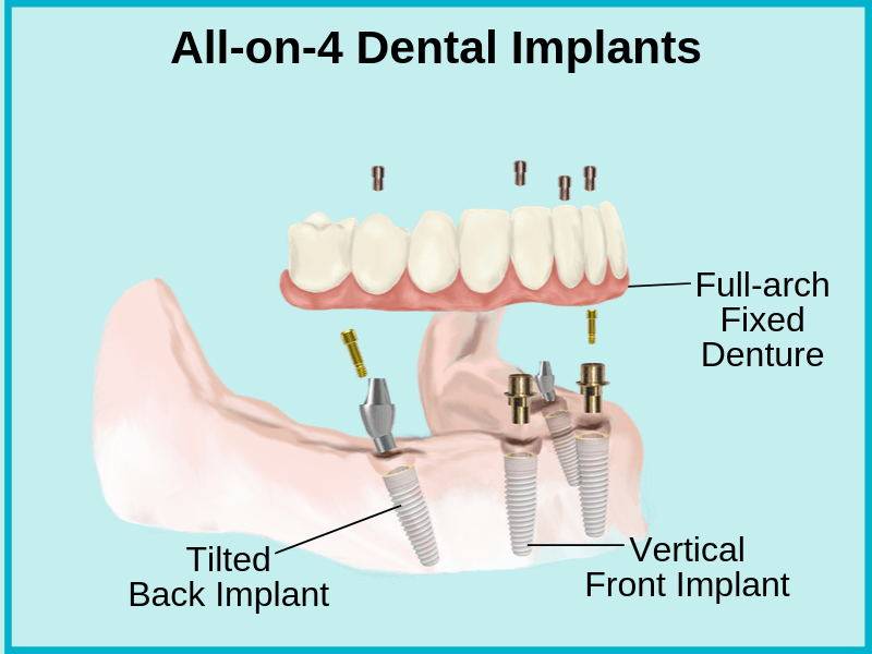 All-on-4 Dental implants in Ahmedabad, India