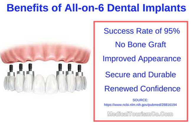 Benefits of All-on-6 Dental Implants