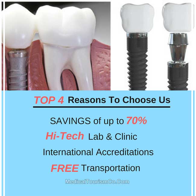 Why Choose Us For Dental Implants