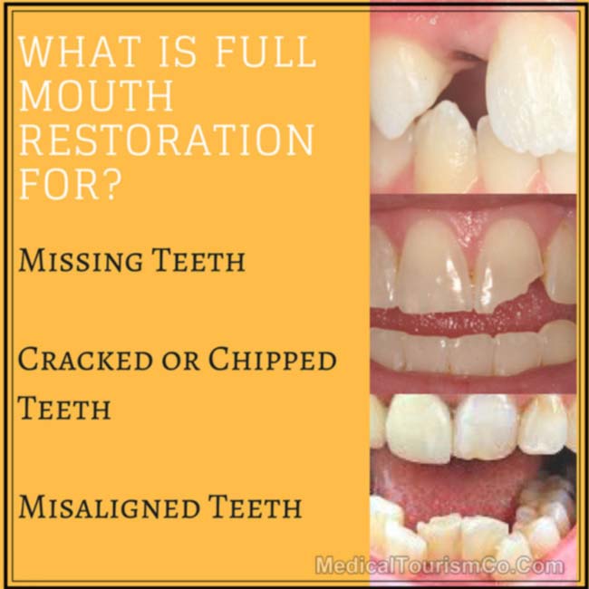 What is full mouth restoration?