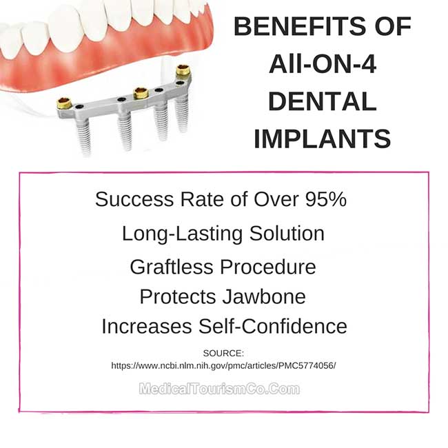 Benefits of All-on-4 Dental Implants