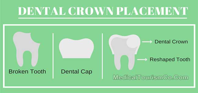 Dental Crown Placement Process