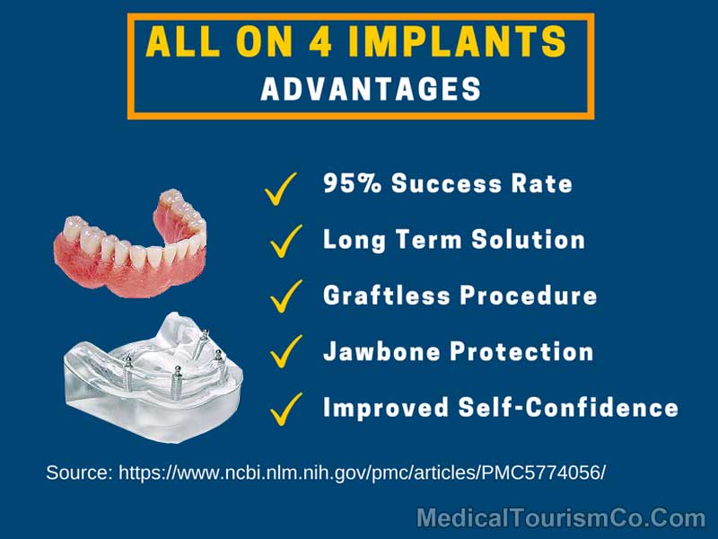 All on Four Implants - Advantages