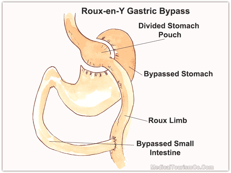 Mini Gastric Bypass Vs Gastric Bypass- RNY Gastric bypass