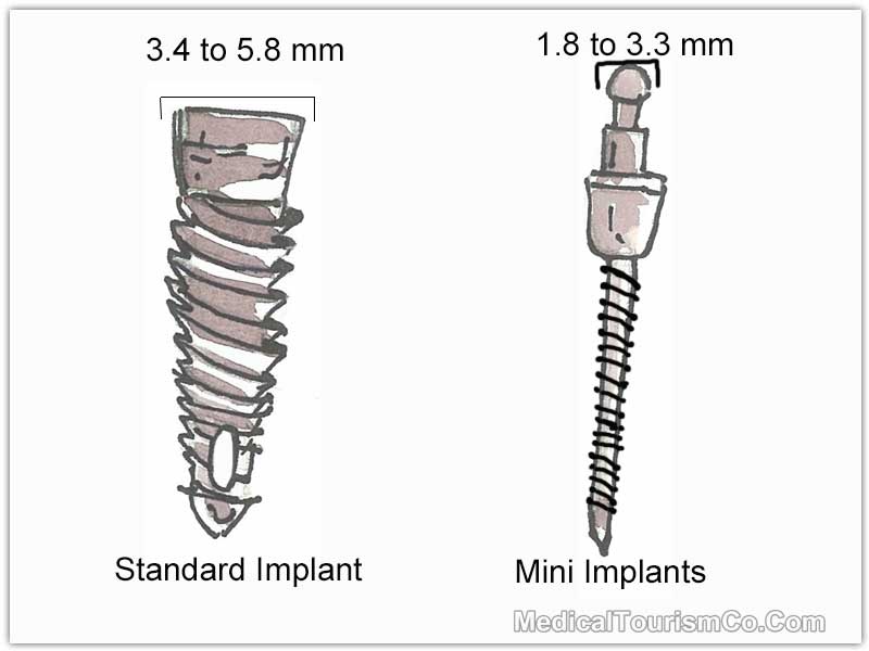 Standard Versus Mini Dental Implants- colombia