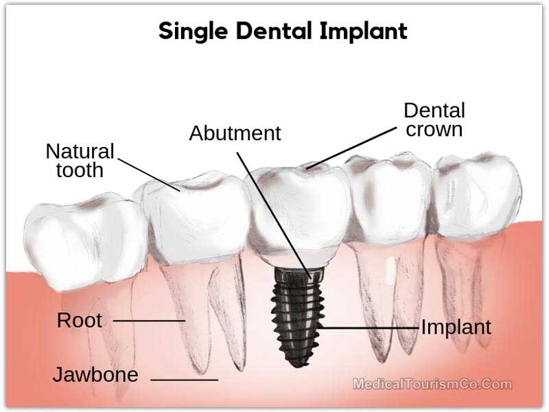 Dental Implants in Cancun - Mexico