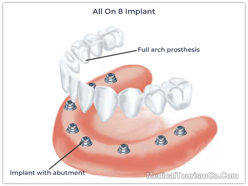 All-on-8 Dental Implant