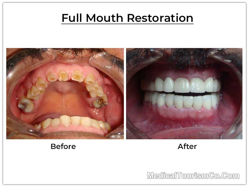 Full Mouth Restoration Mexico Before After