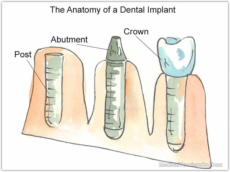 The Anatomy of a Dental Implant