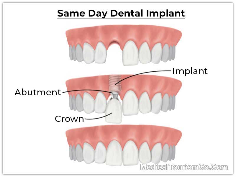 Same Day Dental Implant in Ahmedabad