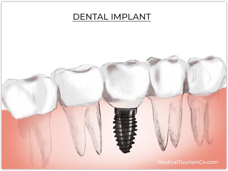 Dental Implant Phuket