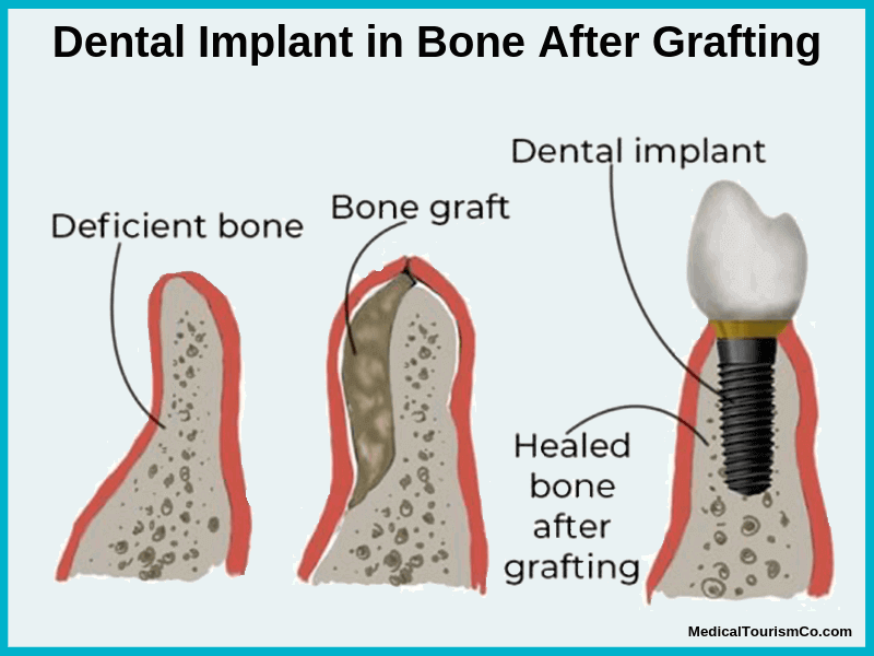 Bone grafting before Dental Implant in Colombia