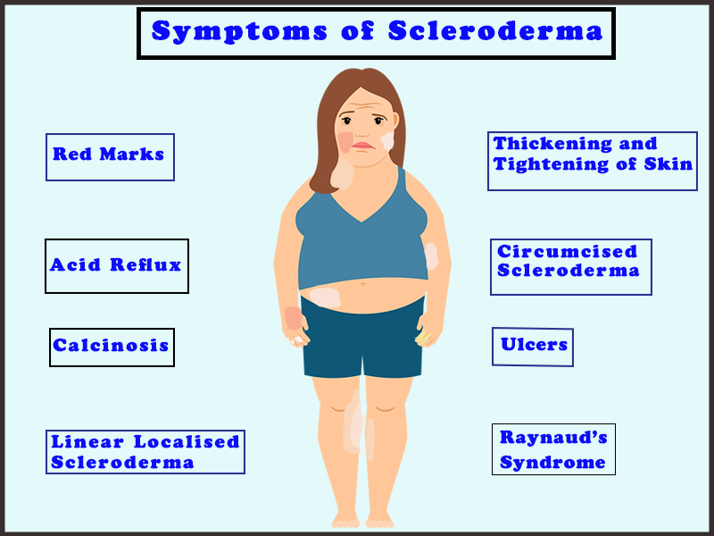 Symptoms of Scleroderma
