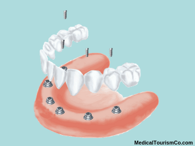 All-on-6 dental implants