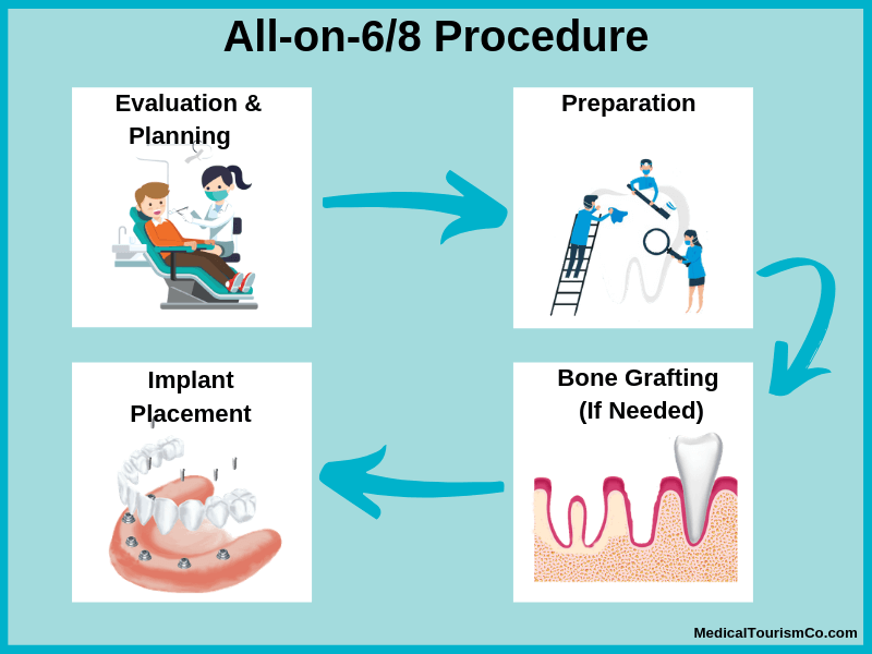 all-on-6 and 8 procedure