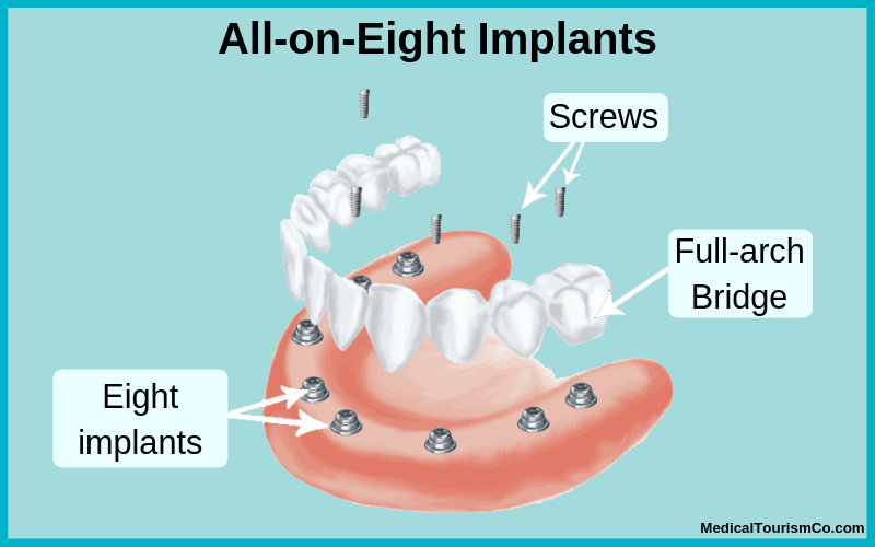 All-on-8 dental implants illustration