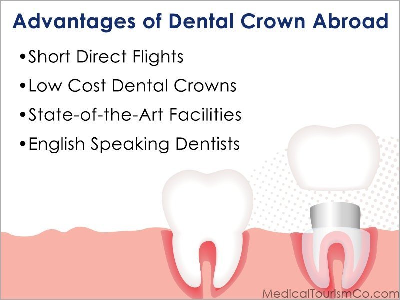 Advantages Associated with Abroad Dental Crown