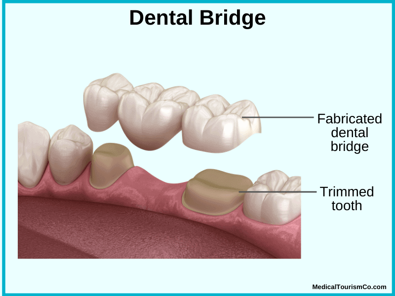 Dental Bridge in Cambodia