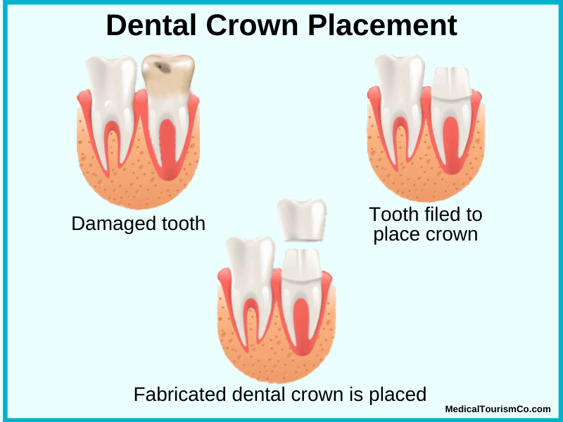 Dental Crown Procedure Abroad
