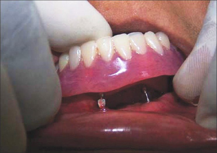 Mini Dental Implant & Denture