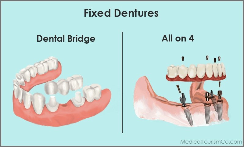 Bridge Vs Implant based fixed dentures abroad