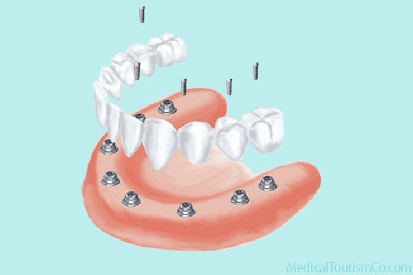 All-on-8 Implant based Dentures