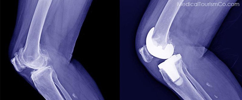 X-ray of knee: pre and post surgery