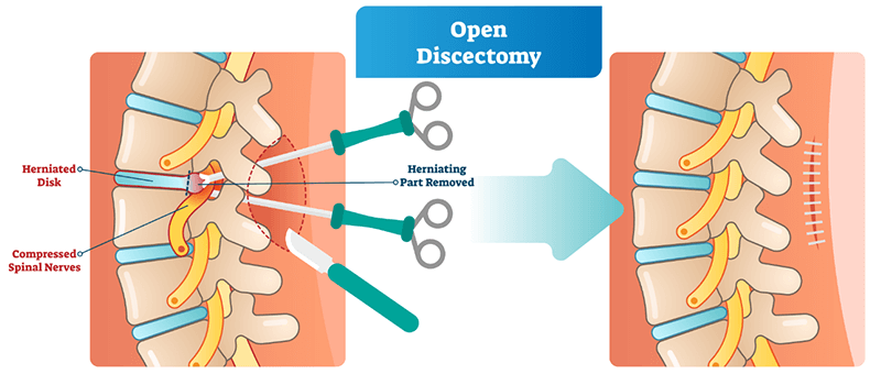 Discectomy - Spinal Surgery in India