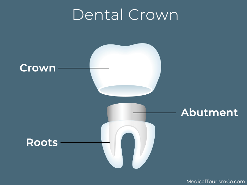 Dental Crown in Cambodia