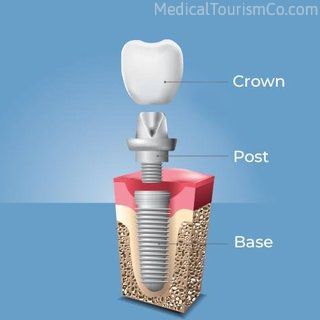 Dental Implant | Dental Implants in Cartagena
