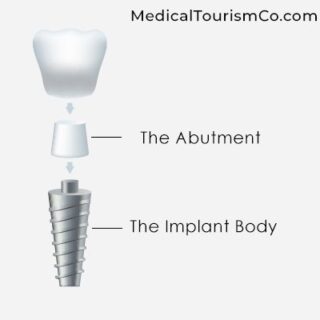 Titanium Implant | Dental Implants in Cartagena