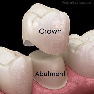 Porcelain Crown | Dental Implants in Cartagena