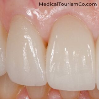 Zirconia Crown | Dental Implants in Cartagena