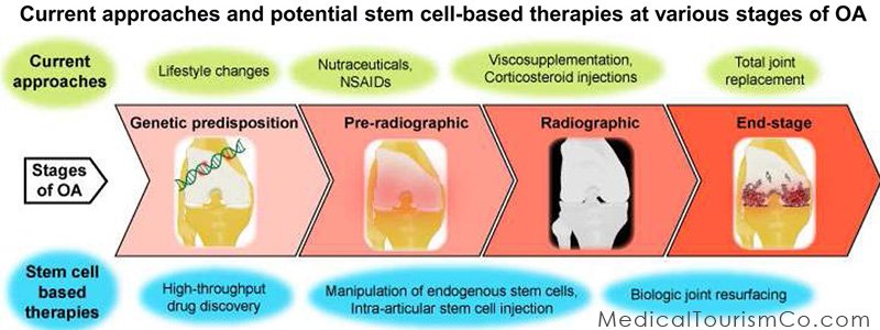 Stem Cells for Osteoarthritis in India