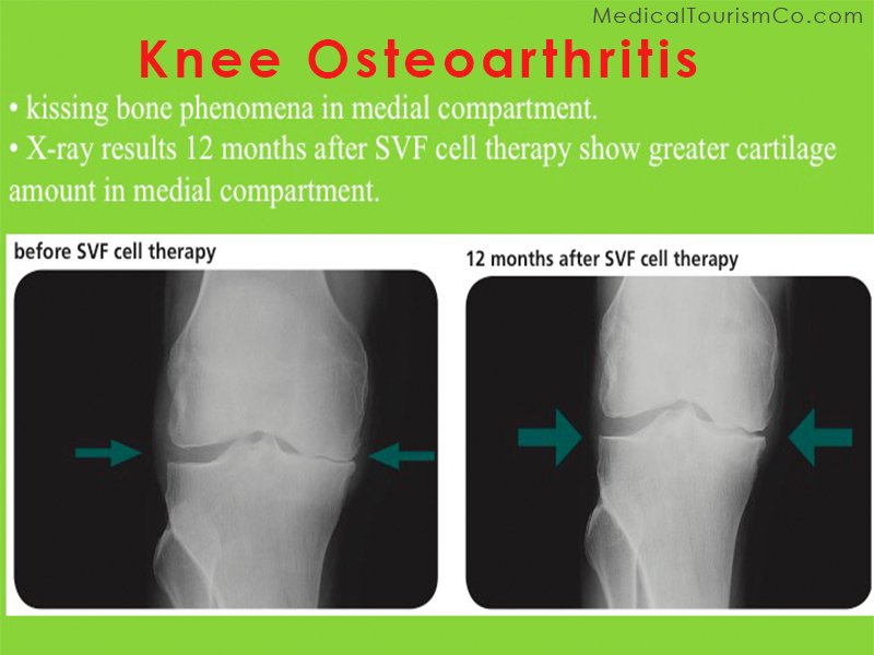 Stem Cell Therapy for Osteoarthritis Knee in India