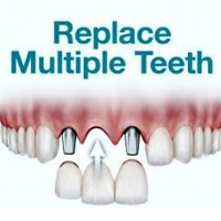 Multiple Teeth Replacement | Cancun Cosmetic Dentistry
