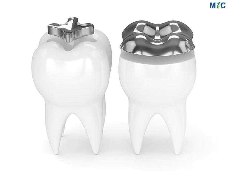 Inlay and Onlay | Cancun Cosmetic Dentistry