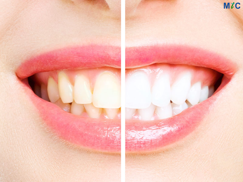 Teeth Whitening | Cancun Cosmetic Dentistry