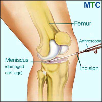 Knee meniscus surgery in Izmir
