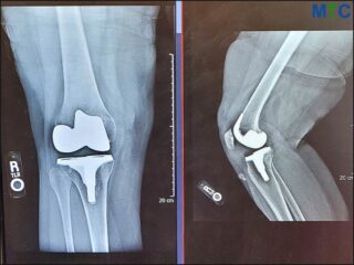 Full Knee Joint Replacement X-ray