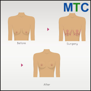 Breast lift in Cancun, Mexico