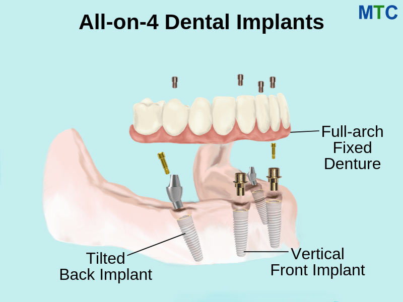 All on 4 Dental Implants in Nuevo Progreso