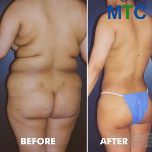 Liposuction in Tijuana | Before & After photos