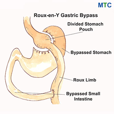 Gastric Bypass- Weight Loss Surgery in Mexico